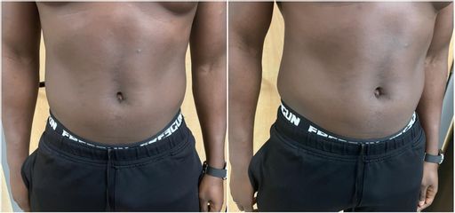 EMSculpt® - Dr Léonard Kimbaloula