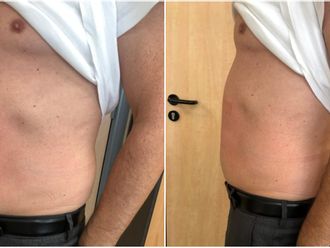 EMSculpt® avant et après - 841080
