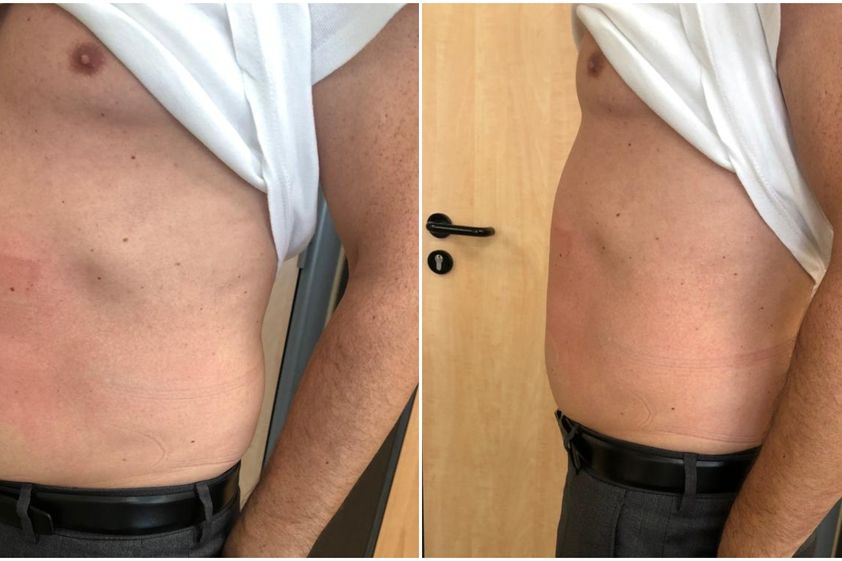 EMSculpt® avant et après - 841080
