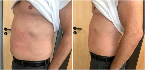 EMSculpt® - Dr Léonard Kimbaloula