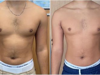 EMSculpt® avant et après - 841081