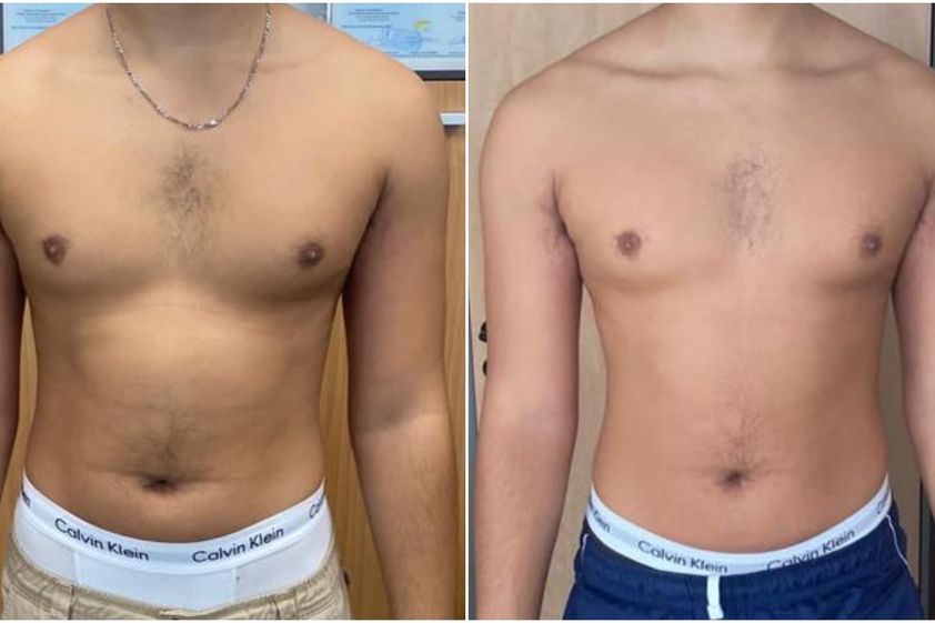 EMSculpt® avant et après - 841081