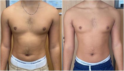 EMSculpt® - Dr Léonard Kimbaloula