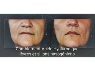Acide hyaluronique - Dr Lionel Ferrier