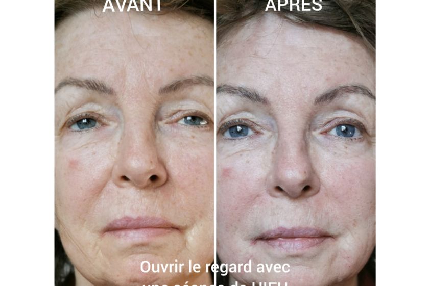 HIFU avant et après - 807692
