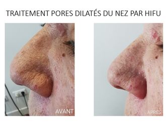 HIFU avant et après - 815854