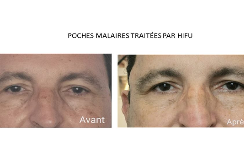 HIFU avant et après - 844689
