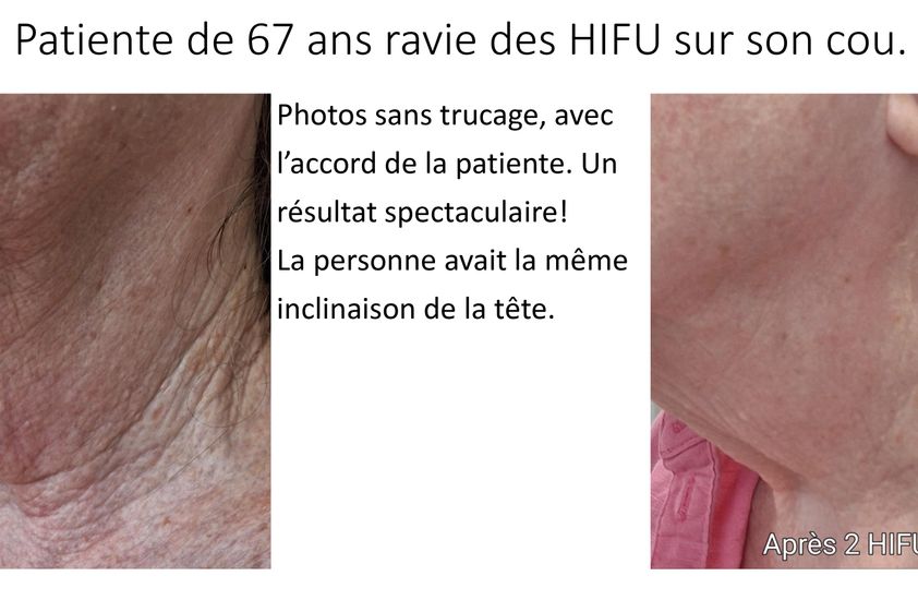 HIFU avant et après - 857337