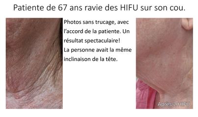 HIFU - Dr Lionel Ferrier