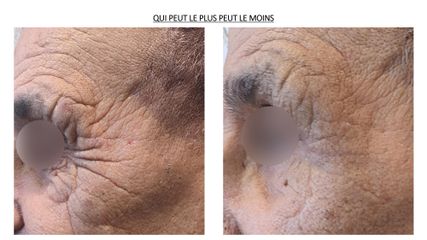 Acide hyaluronique - Dr Lionel Ferrier