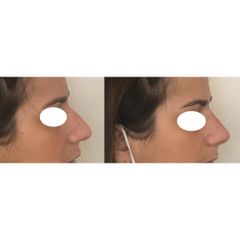 Rhinoplastie - Dr Eugenio Broccaioli