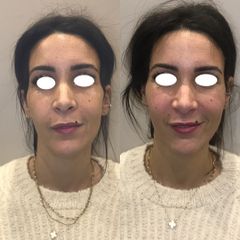 Rhinoplastie médicale - Dr Eugenio Broccaioli