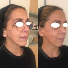 Rhinoplastie - Dr Eugenio Broccaioli