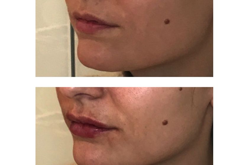 Augmentation des lèvres avant et après - 811669