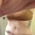 Abdominoplastie ratée