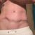 Abdominoplastie ratée