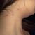 Laser/peeling dermatologique contre cicatrices d’acnés et tache pigmentaire 