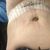 Abdominoplastie: Ça y est, je l’ai fait !