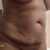 Confiance en son corps retrouvée après une abdominoplastie