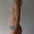 Augmentation mammaire par lipofilling
