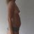 Augmentation mammaire par lipofilling