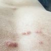 Chéloide sur le torse