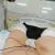 Abdominoplastie + lifting du pubis+ nymphoplastie