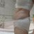 Abdominoplastie avec liposuccion