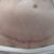 Abdominoplastie avec liposuccion