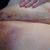 Abdominoplastie + lipoaspi 1er juillet 2021