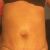 Une abdominoplastie qui a changé ma vie