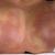 Lipofilling mammaire