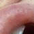Boules après injection d'acide hyaluronique dans les lèvres