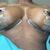 Chirurgie avec implants Motiva : Augmentation mammaire et lifting