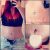 Abdominoplastie hernie diastasis et augmentation mammaire