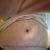 Abdominoplastie après 3 grossesses