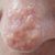 Greffe sur le nez suite à une opération d'un carcinome