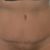 Abdominoplastie après grossesses, très contente !