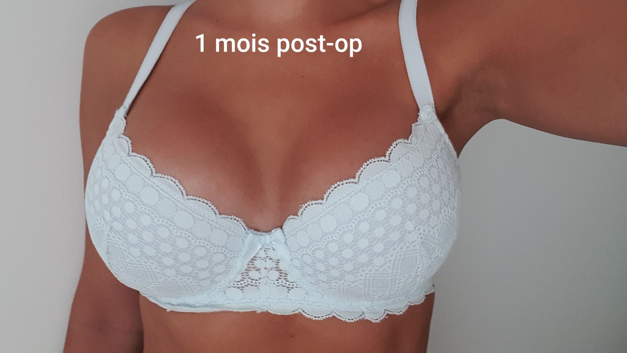 r-sultat-1-mois-post-op-augmentation-mammaire-multiesthetique-fr