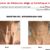 Résultats sublimes de mes injections d'acide hyaluronique !