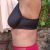 Abdominoplastie et Lifting du dos ± liposuccion