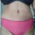 Abdominoplastie et Lifting du dos ± liposuccion