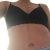 L abdominoplastie a changé ma vie