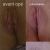 Réduction des lèvres, liposuccion du pubis, resserrage du U en V d'origine et lift du clitoris