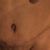 Abdominoplastie bientôt J-14