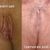 Réduction des lèvres, liposuccion du pubis, resserrage du U en V d'origine et lift du clitoris