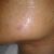 Je un gros problème de peau ,troue,cicatrice,microkyste, je voudrais telement une peau de poupée , impacte sur ma vie privée j'ai 33ans es toujours pas marié.
