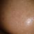 Je un gros problème de peau ,troue,cicatrice,microkyste, je voudrais telement une peau de poupée , impacte sur ma vie privée j'ai 33ans es toujours pas marié.