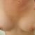 Augmentation mammaire avec des implants de 320cc