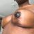 Enfin j’aime ma poitrine après mon lifting des seins (mastopexie)